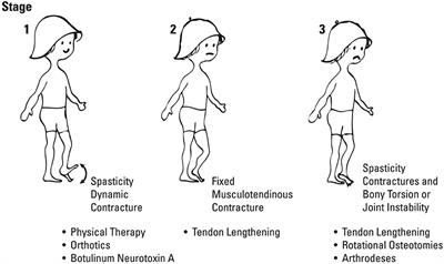 Skeletal Muscle in Cerebral Palsy: From Belly to Myofibril